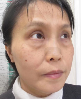 年纪大了照样做眼袋!效果怎样?600 年纪大了照样做眼袋!效果怎样?600