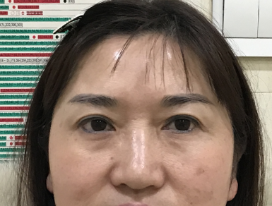 去眼袋手术