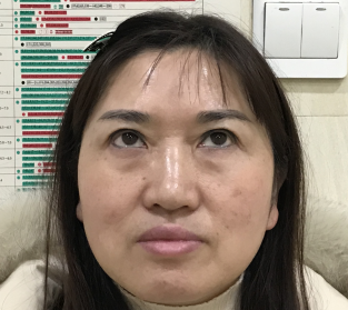 去眼袋手术