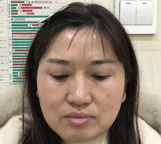 去眼袋手术