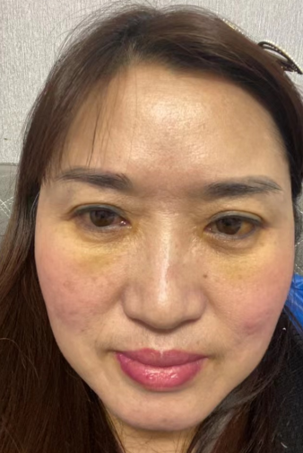 去眼袋手术
