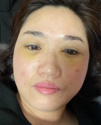 去眼袋手术