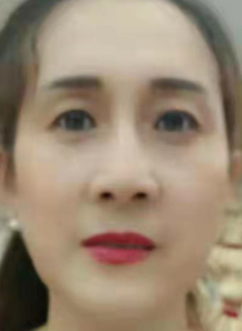 去眼袋手术