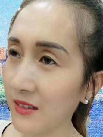 去眼袋手术