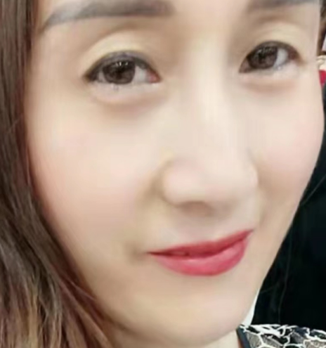 去眼袋手术