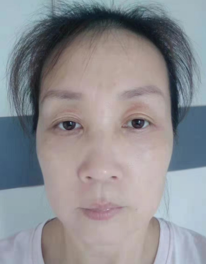 去眼袋手术