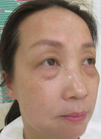 去眼袋手术