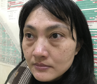 去眼袋手术