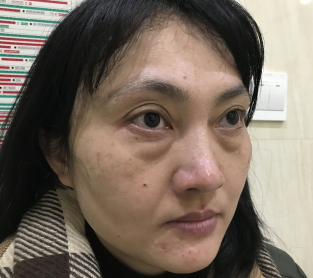 去眼袋手术