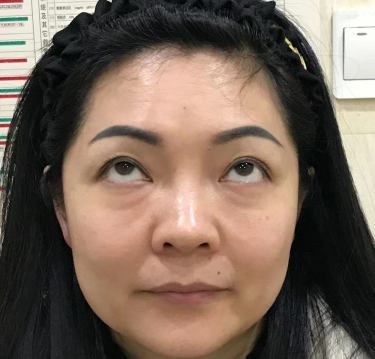 去眼袋手术