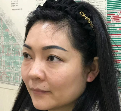 去眼袋手术