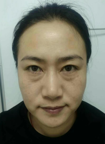 去眼袋手术