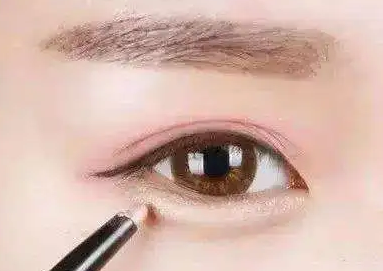 去眼袋手术