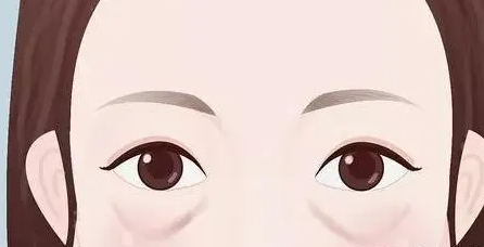去眼袋手术