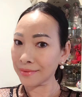去眼袋手术