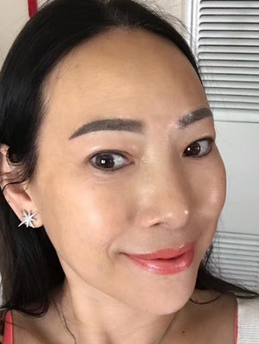 去眼袋手术
