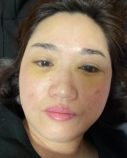 详细记录下不开刀按摩去眼袋手术的恢复历程！624