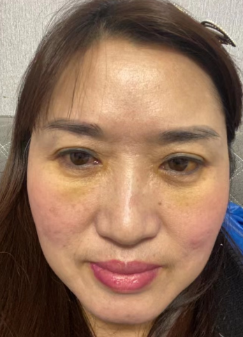 去眼袋手术