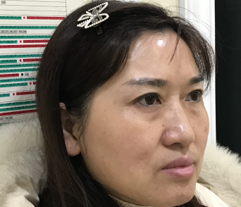 去眼袋手术