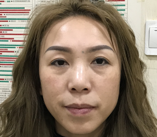 去眼袋手术