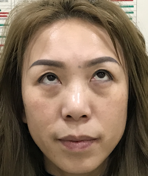去眼袋手术