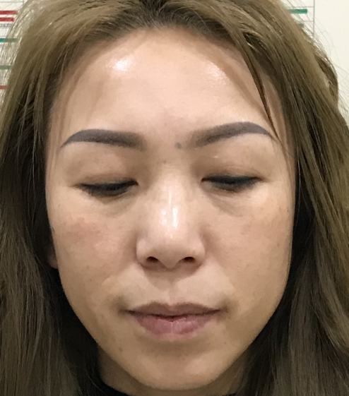去眼袋手术
