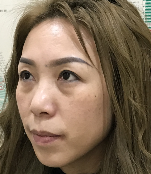 去眼袋手术
