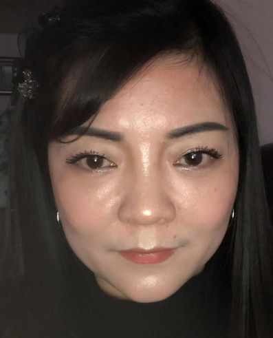 去眼袋手术