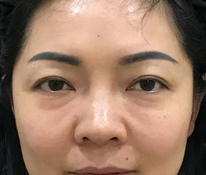 去眼袋手术