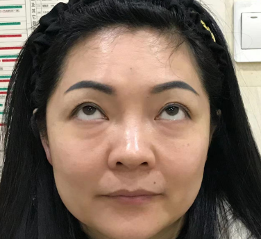 去眼袋手术
