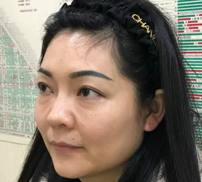 去眼袋手术