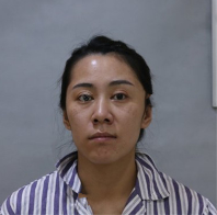 去眼袋手术