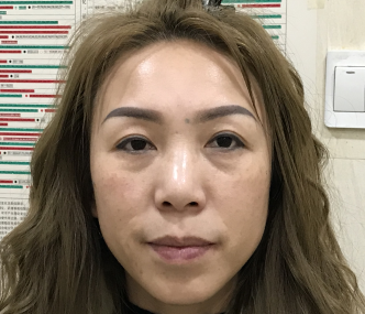 去眼袋手术