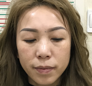 去眼袋手术