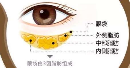 去眼袋手术