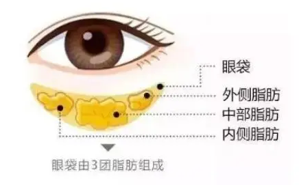 去眼袋手术