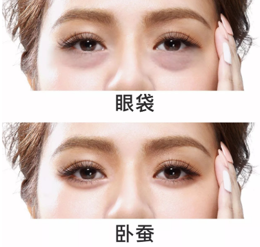 去眼袋手术