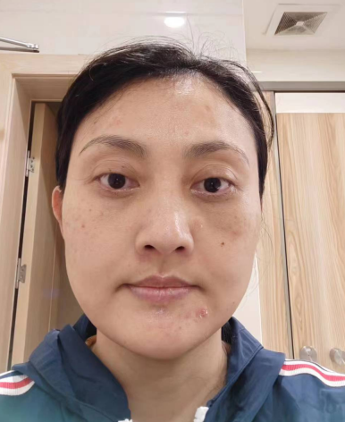 去眼袋手术