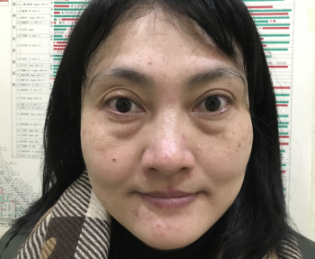 去眼袋手术