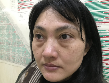 去眼袋手术