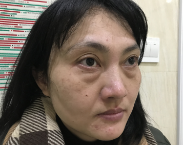 去眼袋手术
