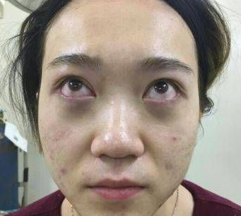 去眼袋手术