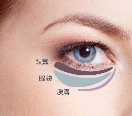 去眼袋手术