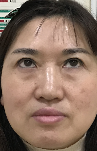 去眼袋手术