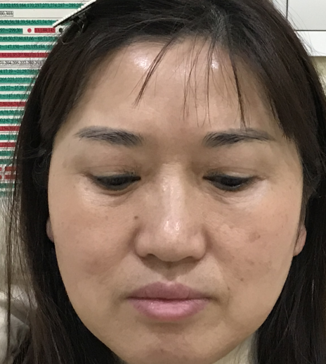 去眼袋手术
