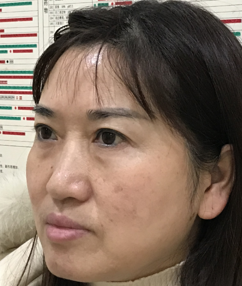 去眼袋手术