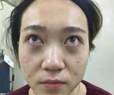 去眼袋手术