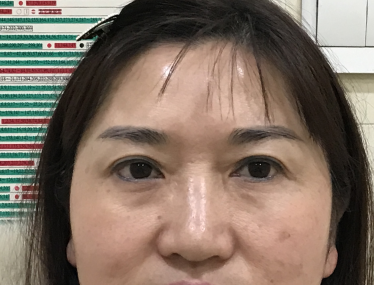 去眼袋手术