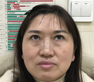 去眼袋手术