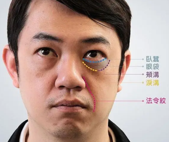 去眼袋手术